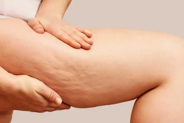 Image of woman showing leg with cellulite Gorgie