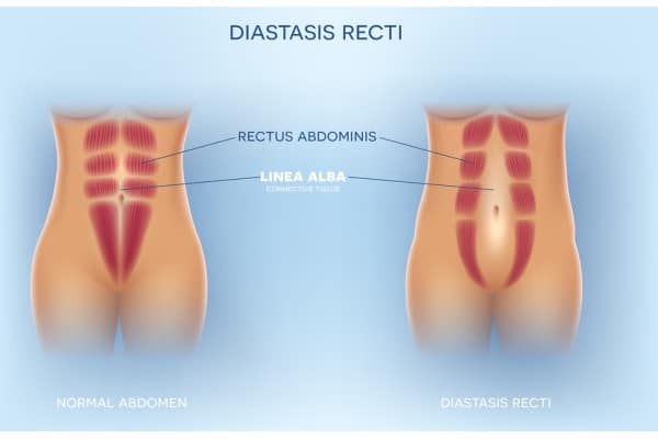What Non-Surgical Options Are Available for Diastasis Recti Gorgie?
