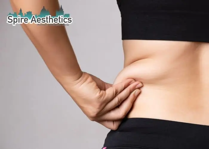 Image of woman pinching fat on their hips Gorgie. Fat Freezing treatment