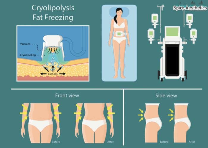 Image of diet and fat freezing combined for best results for Spire Aesthetics Gorgie