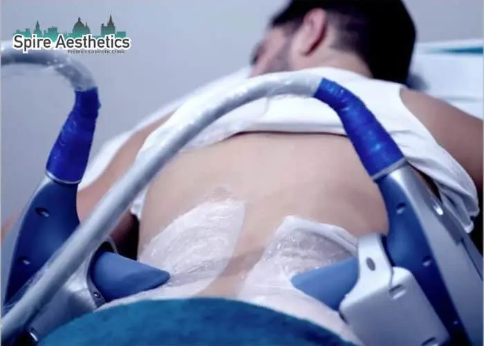 Man having fat freezing treatment done on love handles before a competitions Gorgie to create a sculpted look.