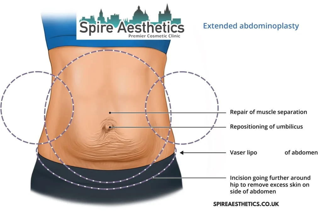 Understanding Loose Skin After Gastric Band Gorgie Surgery and HIFU Treatment