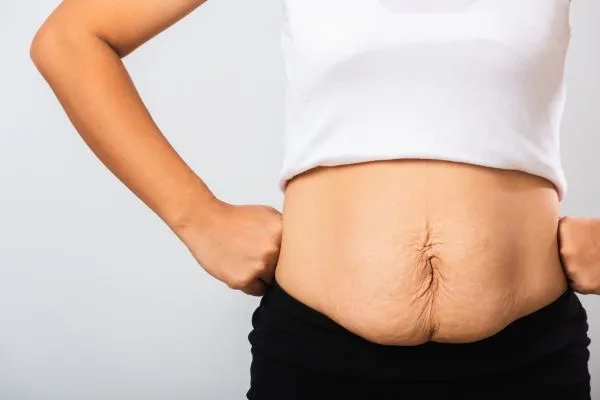 Image of a woman's stomach after weight loss with sagging skin following a gastric band Gorgie