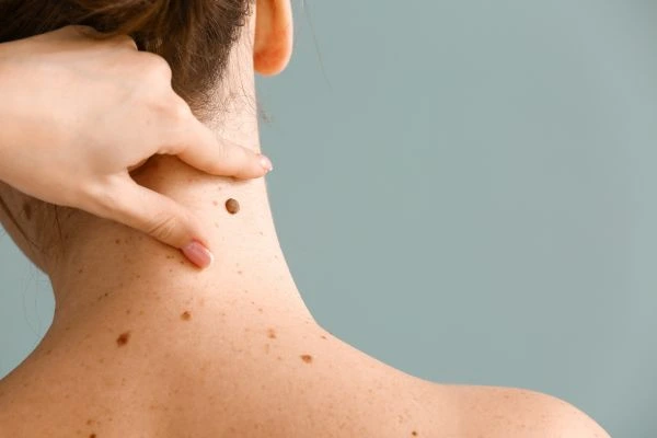skin blemish removal Gorgie treatment