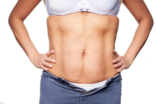 sagging skin on woman's stomach after weight loss injections Gorgie