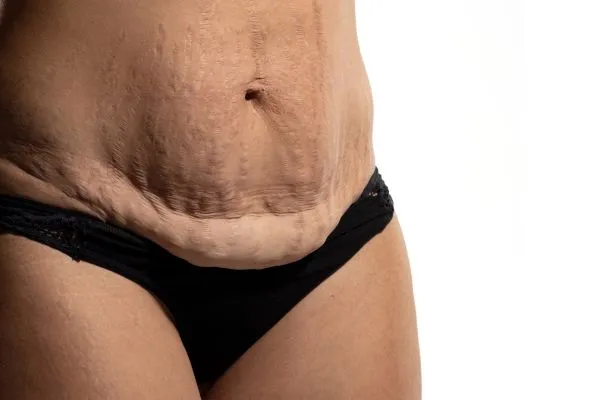 Image of womans stomach after weight loss injections Gorgie showing saggy skin