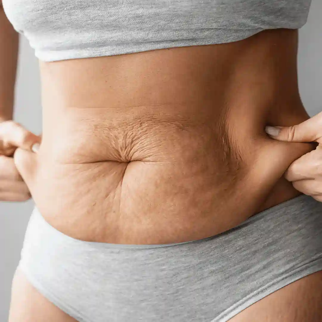 Is It Normal to Have Loose Skin After Pregnancy Gorgie?
